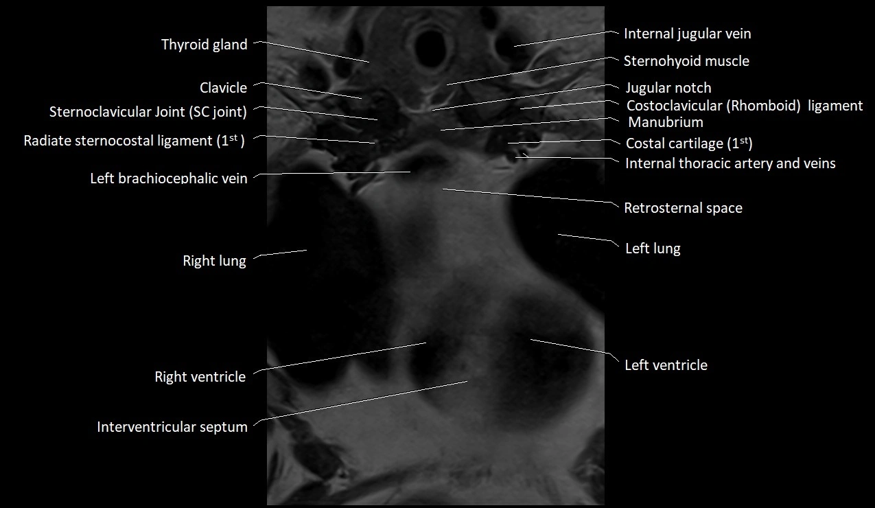 MRI sternum and sternoclavicular joint labeled coronal anatomy image 15.webp